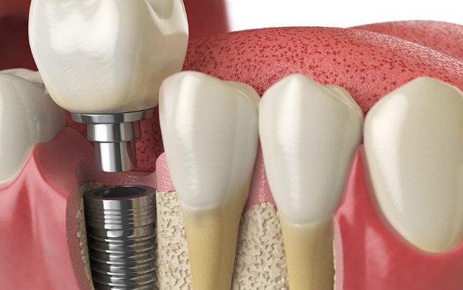 Are Dental Implants Worth It?